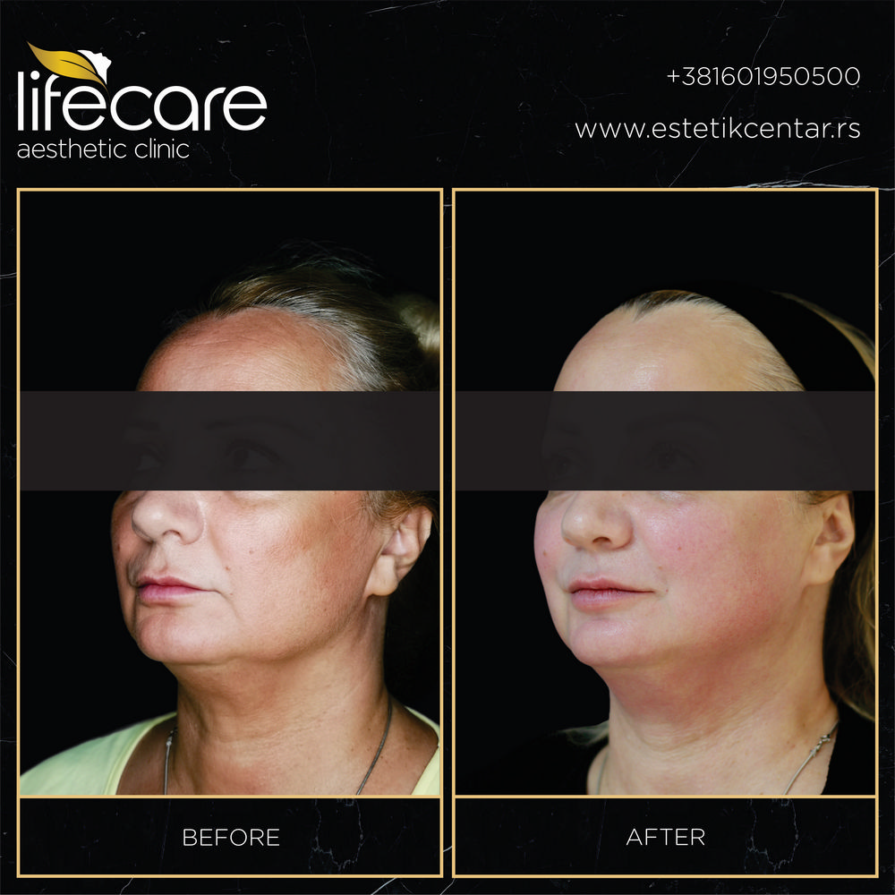 RF Face lift 1-3